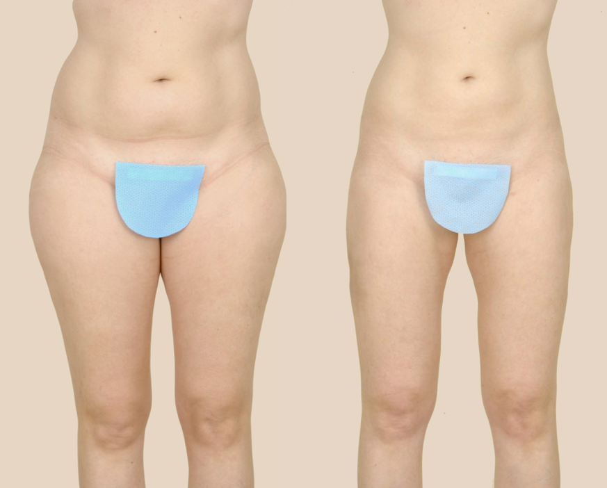 myths of liposuction