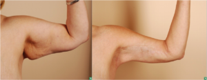 arm lift