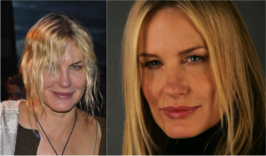 celebrity plastic surgery