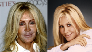 celebrity plastic surgery