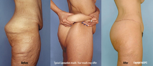Mancoll butt lift  BuildMyHealth