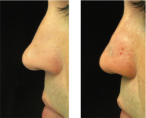 liquid rhinoplasty cost