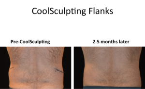 coolsculpting