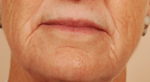 chemical peel