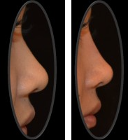 liquid rhinoplasty cost