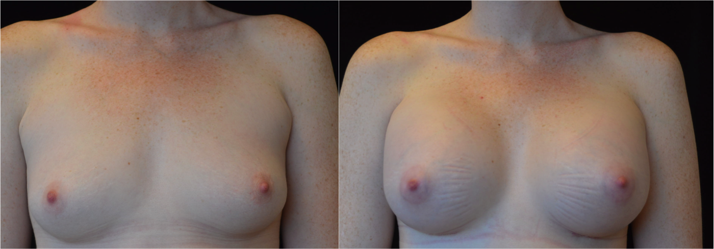 breast augmentation