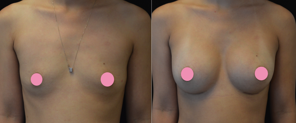 breast augmentation