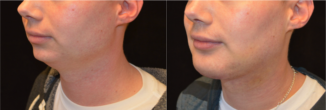 chin augmentation