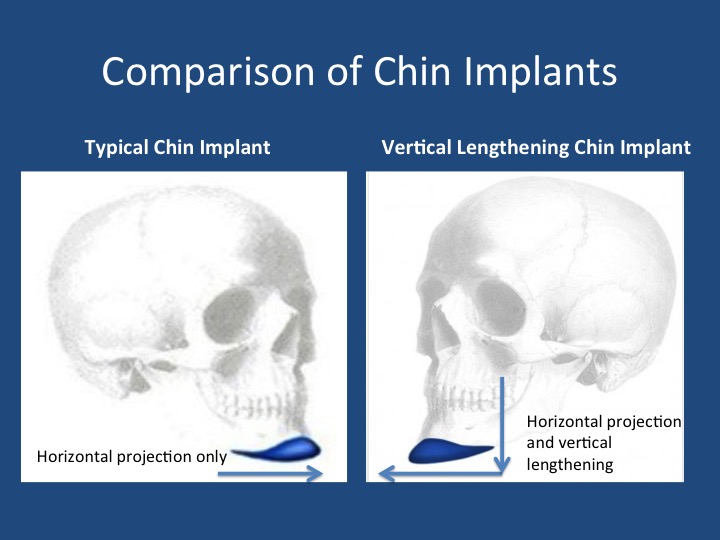 Regular Chin Chin Diagram Strip Thermal Face Lift Double Chin | $68 New Customer