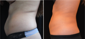 CoolSculpting