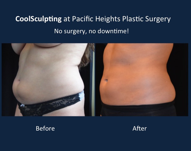 coolsculpting