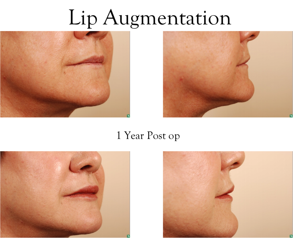 Lip augmentation implants BuildMyHealth
