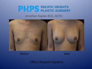 shaped breast implant