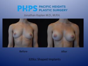 shaped breast implant