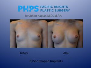 shaped breast implants