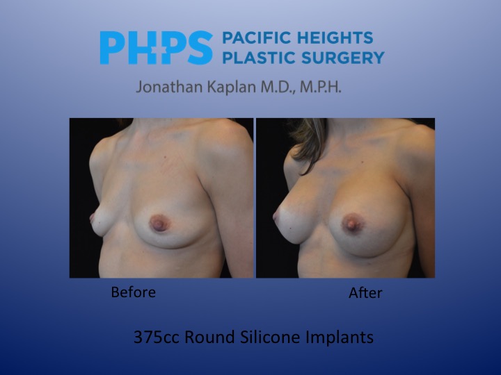 fat injections to the breast