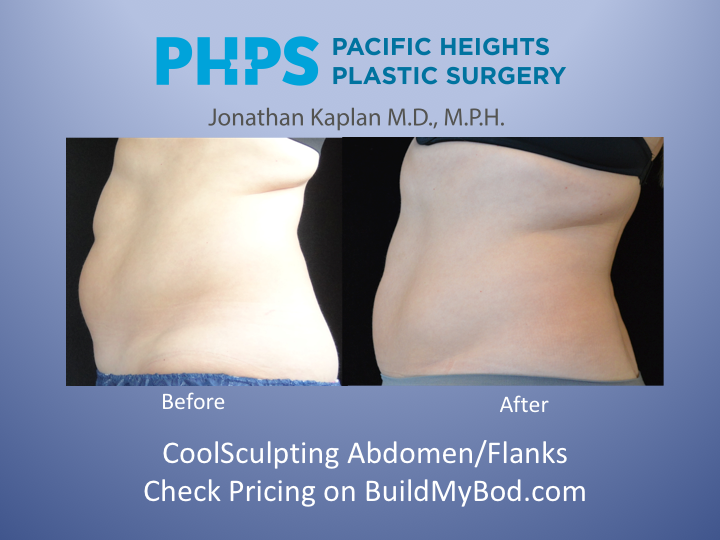 repeat coolsculpting treatments