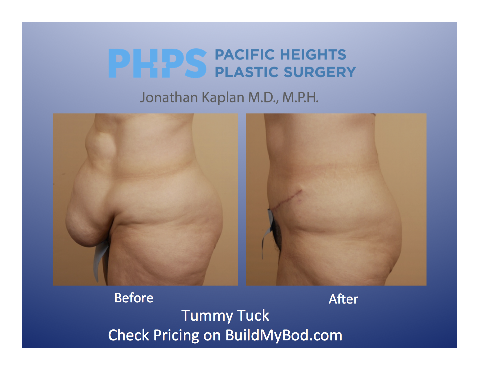 hysterectomy and tummy tuck