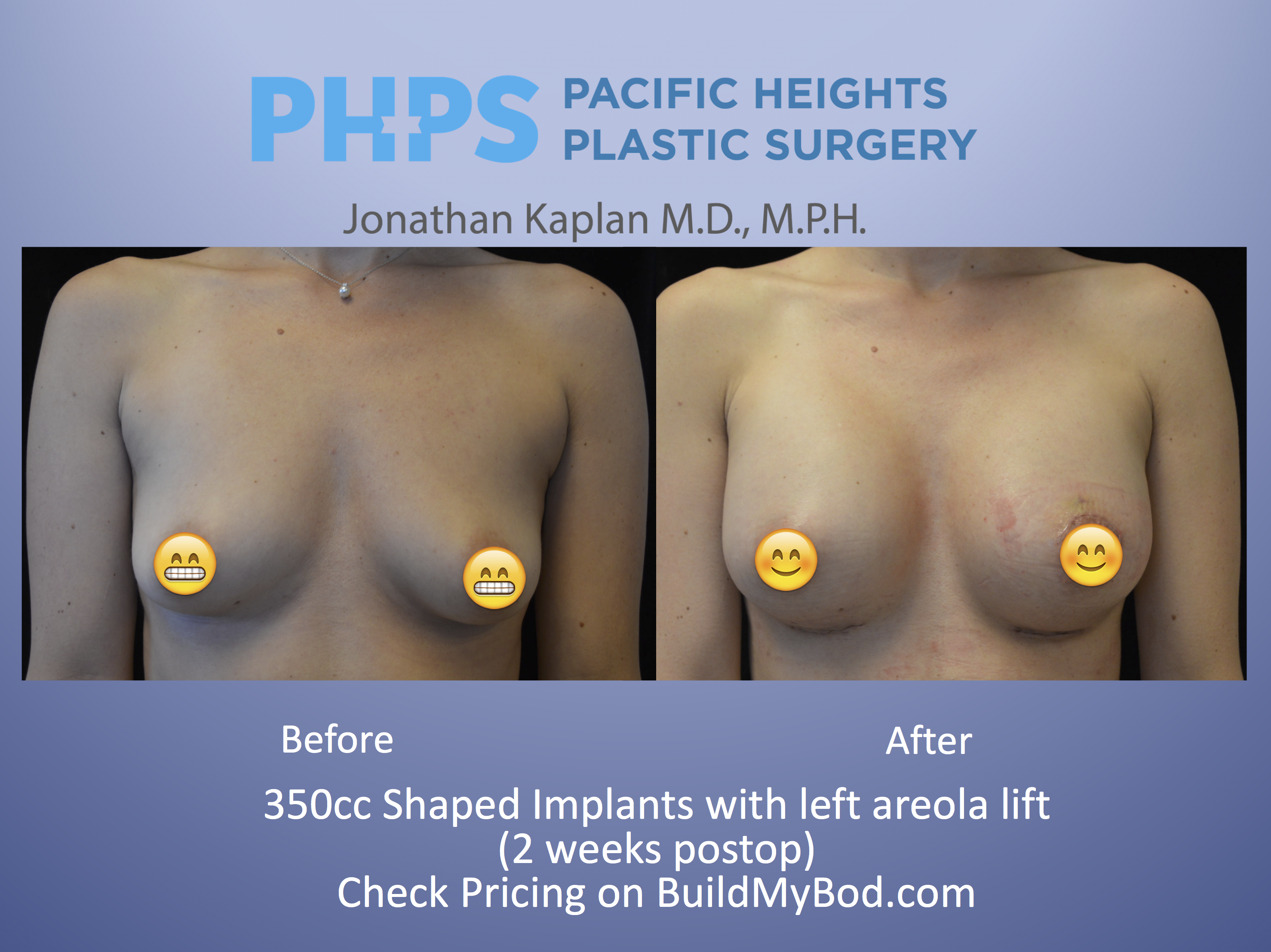 myths of breast augmentation