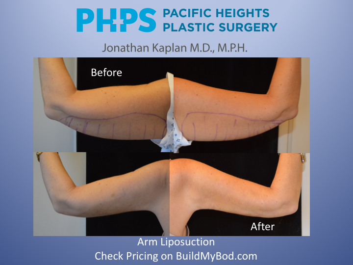 Arm Lift vs Arm Lipo BuildMyHealth