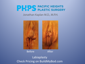 labiaplasty