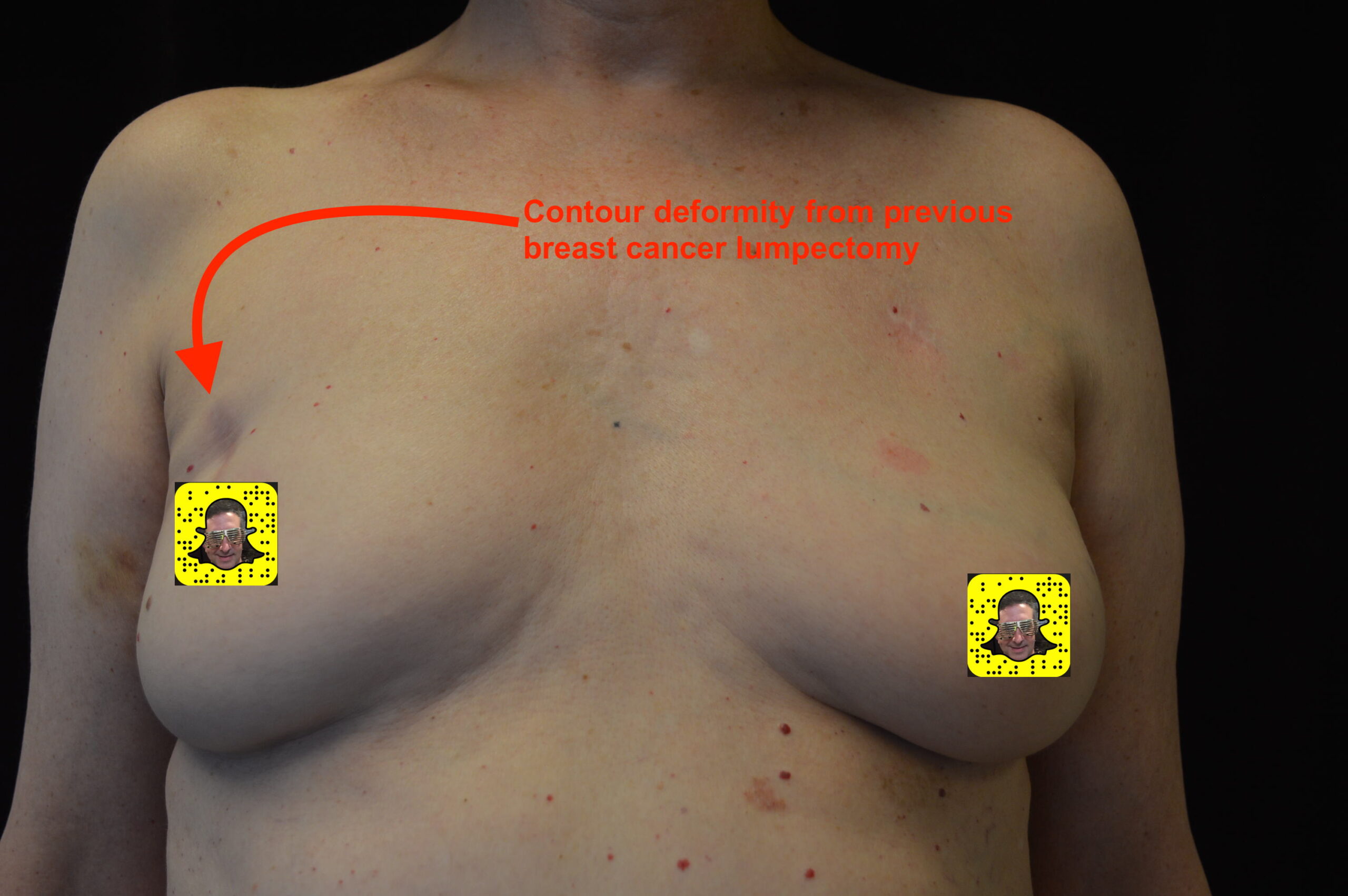 fat injections to the breast