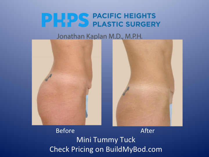 mini tummy tuck