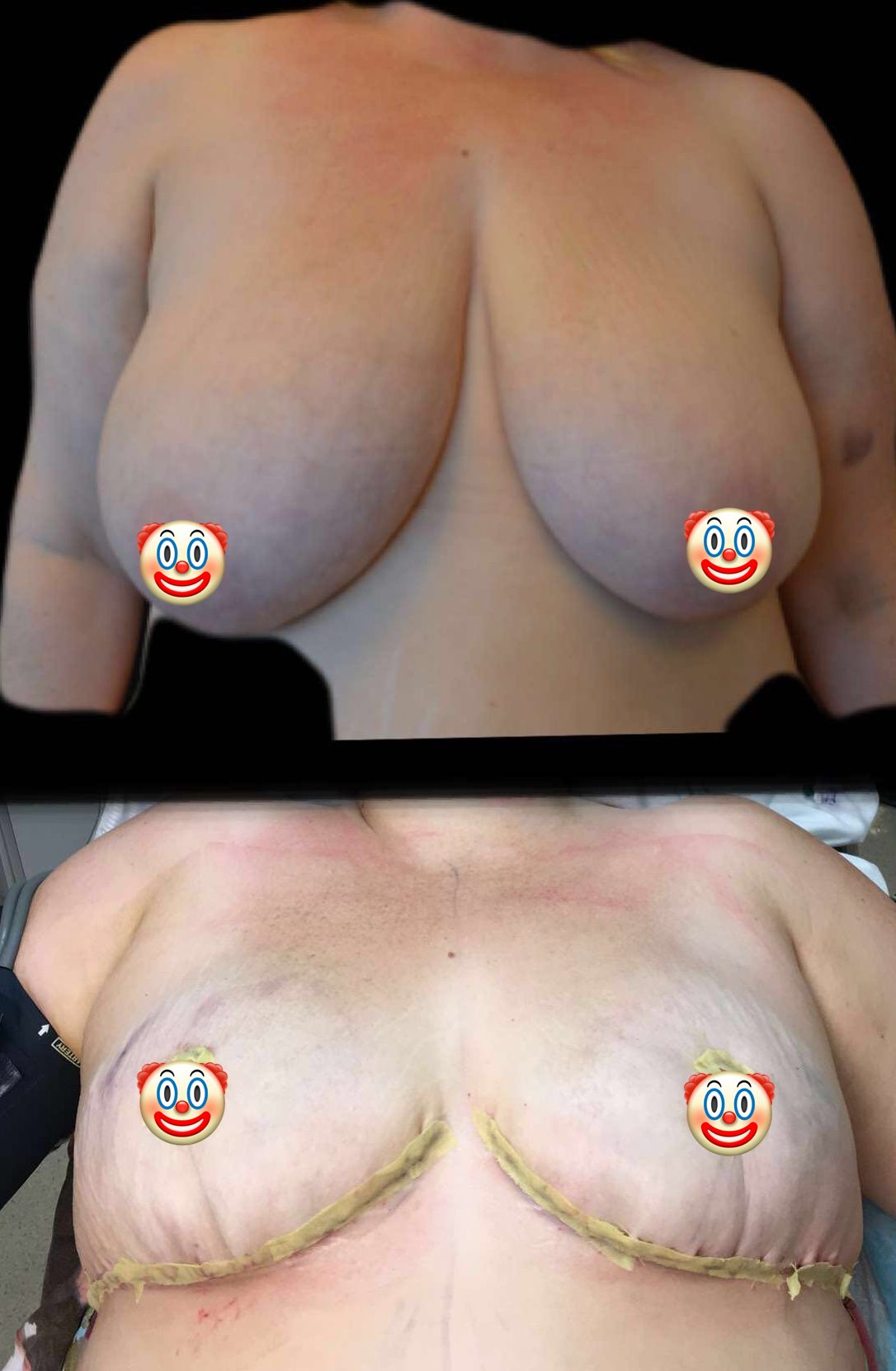 no vertical scar breast reduction