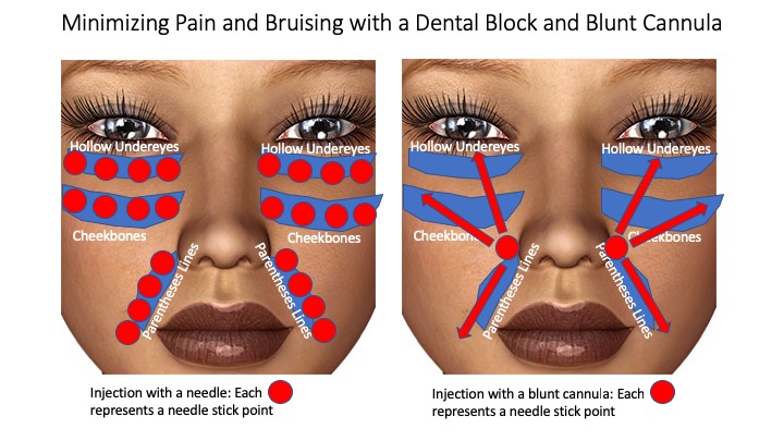 injecting fillers