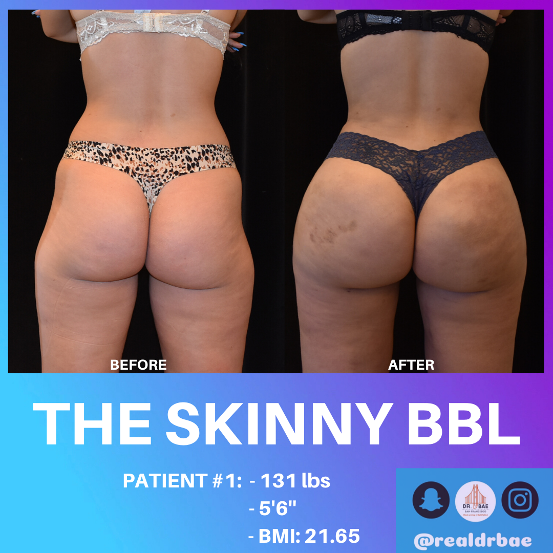 The Skinny BBL (Brazilian Butt Lift) – BuildMyHealth