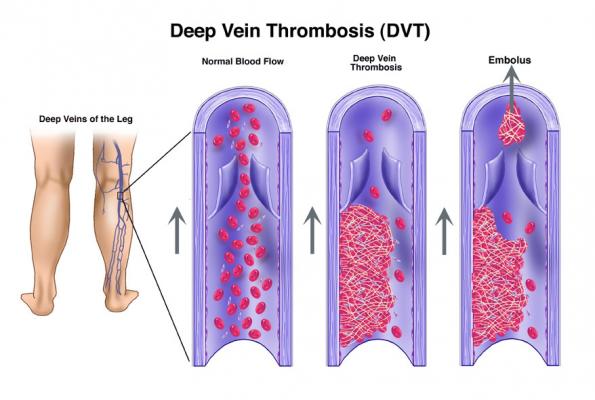 blood clots